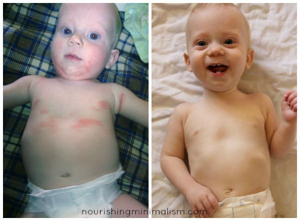 Eczema Before and After